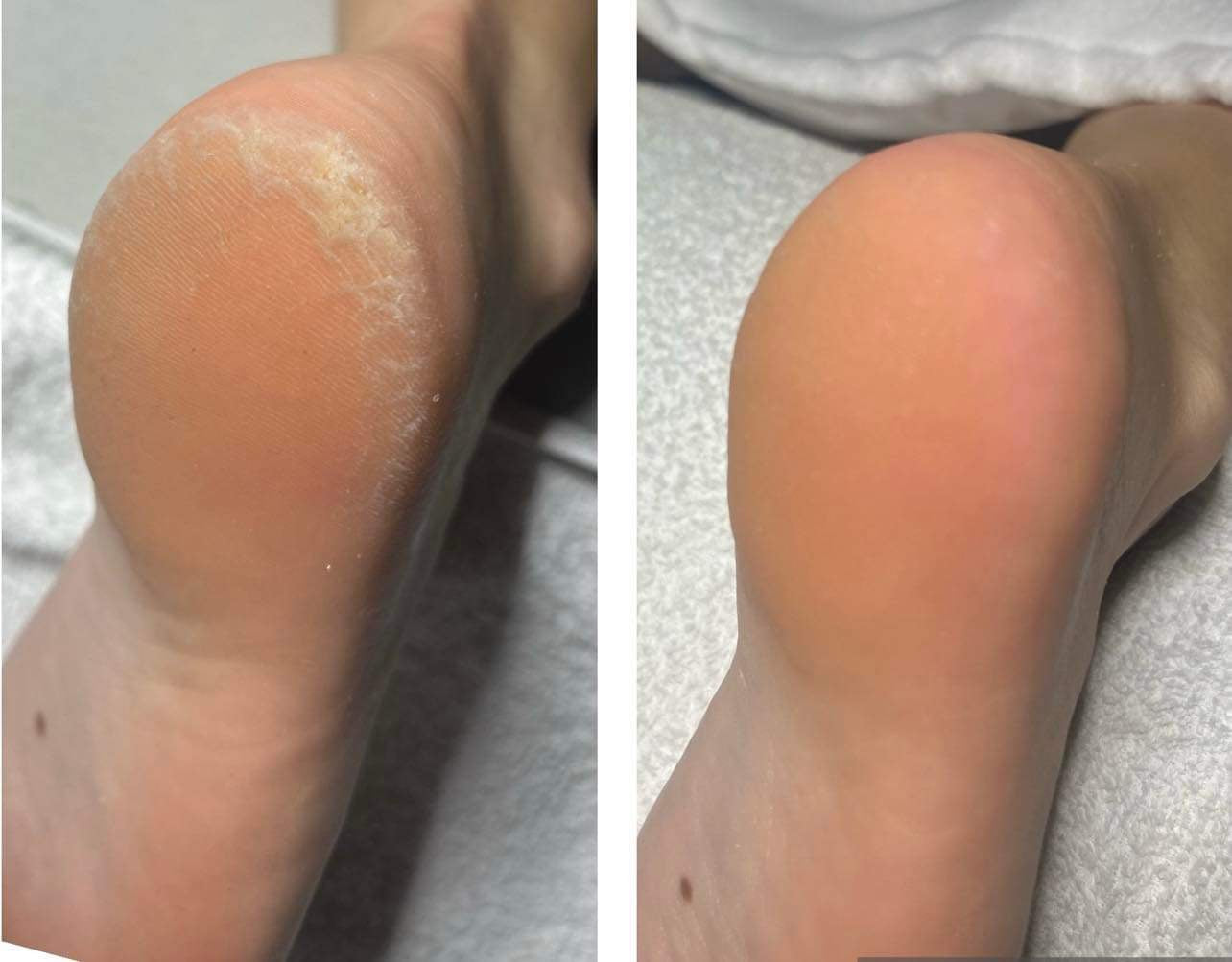 Pédicure + Callus Peel